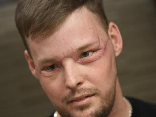 Американцу успешно пересадили лицо, изуродованное 10 лет назад вследствие попытки самоубийства (фото, видео)