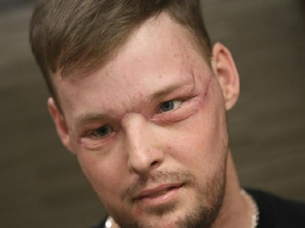 Американцу успешно пересадили лицо, изуродованное 10 лет назад вследствие попытки самоубийства (фото, видео)