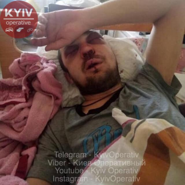 Сломаны нос и челюсть: в Киеве маршрутчик зверски избил пассажира