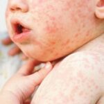 В Одесской области зафиксированы новые случаи кори, один из которых летальный